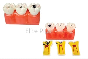 ZX-1512P Dental Caries Model, For Hospital