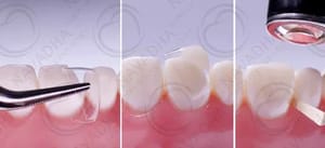 Dental Transparent Strip Crowns Posterior, For Clinical